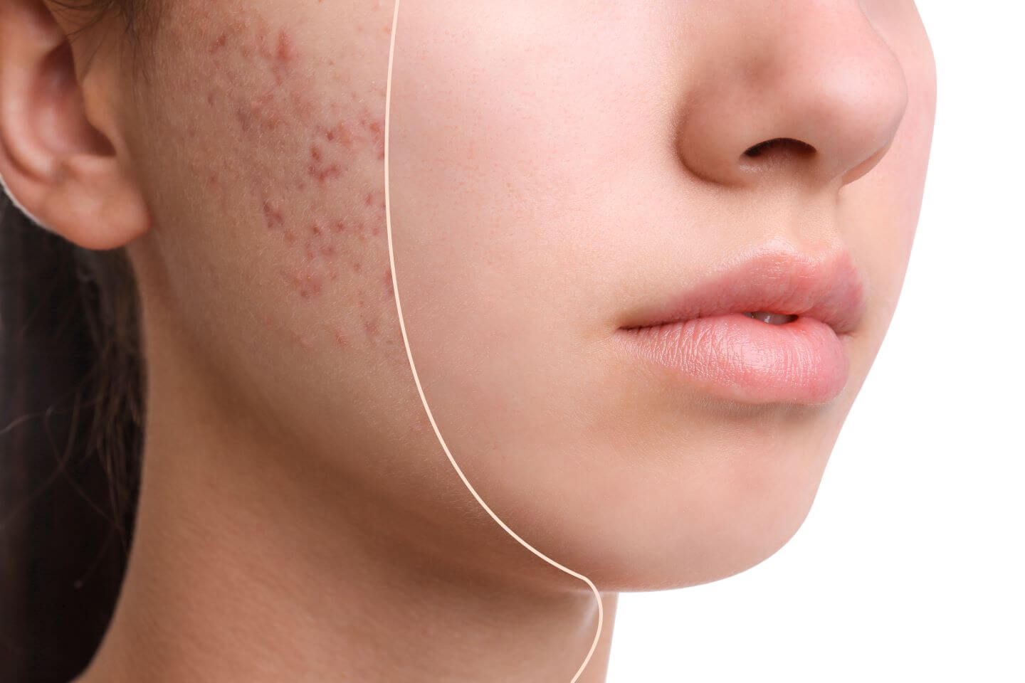 Clearing the Path: Comprehensive Strategies for Acne Management