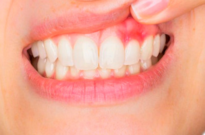 What are the Warning Signs for Gum Problems? 