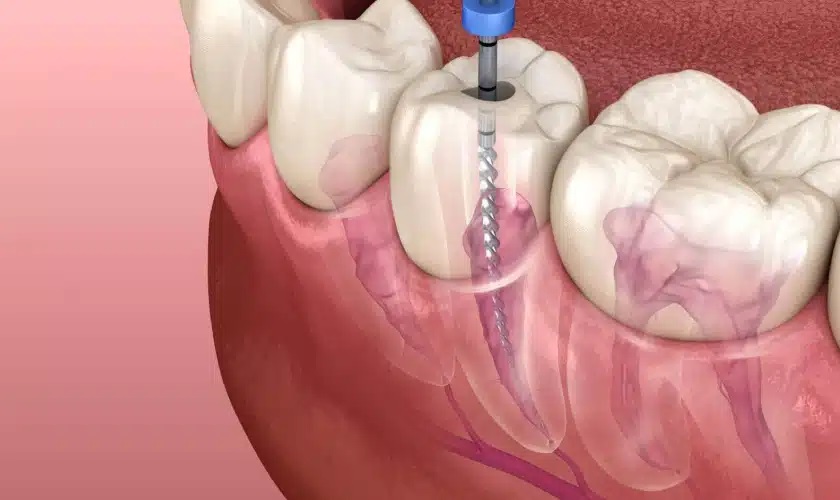 How Teeth Scaling And Root Planning Can Save Your Teeth In the Future